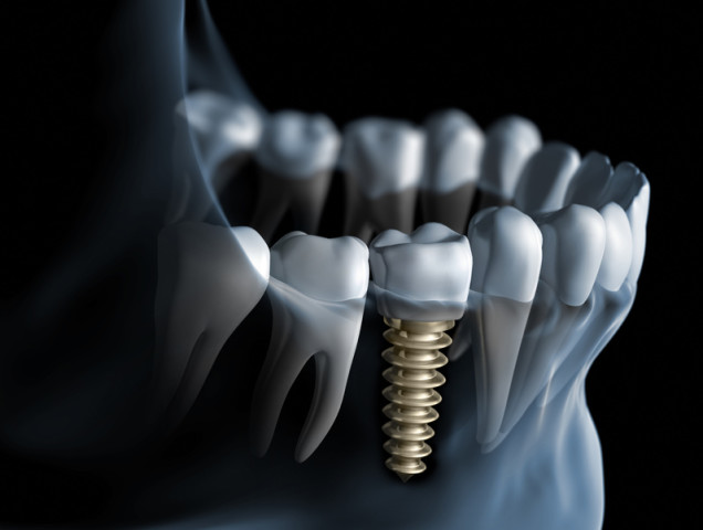 Implante Dentario, historia, origem