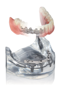 Implante Dentario Carga Imediata All On 4
