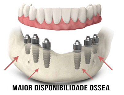 Implante Dentarios- Clinica em Santos