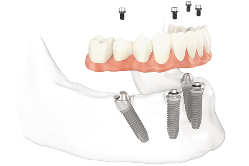tudo em quatro implantes dentarios