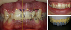 Esthetic Teeth 3D  Smile Analysis -1