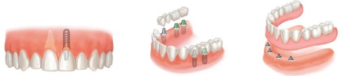 tipos de implante dentario