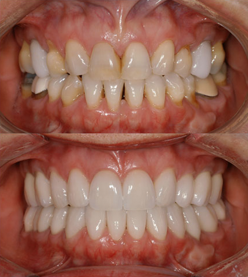 coroas dental santos protese dentaria